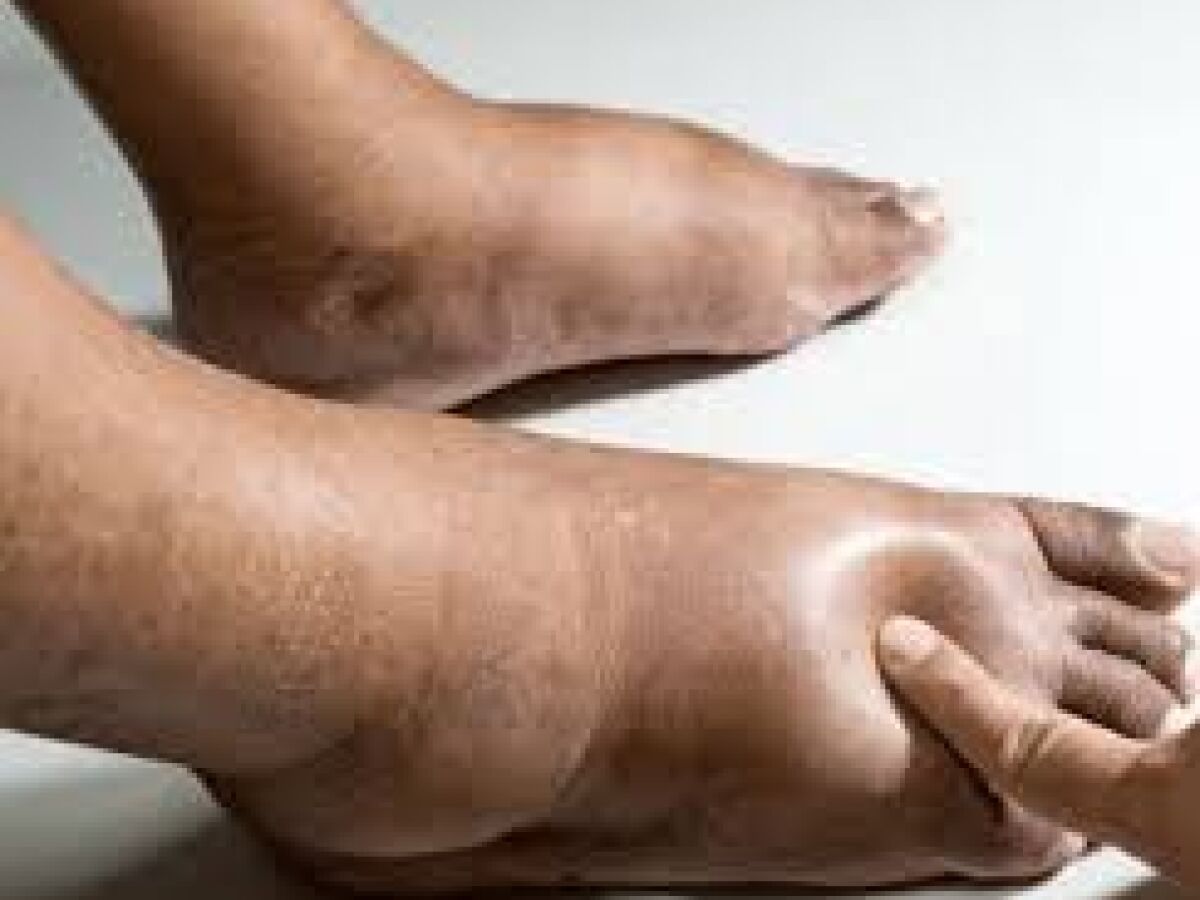 Acúmulo de gordura nas pernas e braços pode ser sinal de lipedema