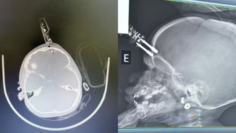 Bebê de 1 ano cai da cama e tem carregador de celular cravado na cabeça