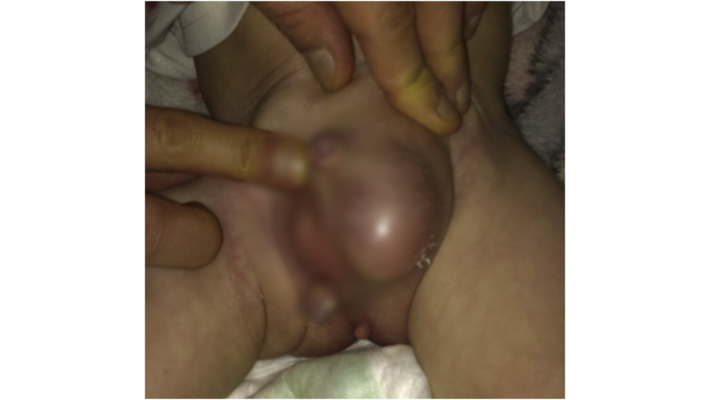 Imagem das genitálias antes da operação 