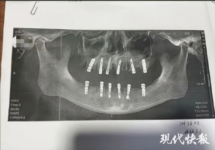 Imagem mostra raio-x do paciente durante o procedimento