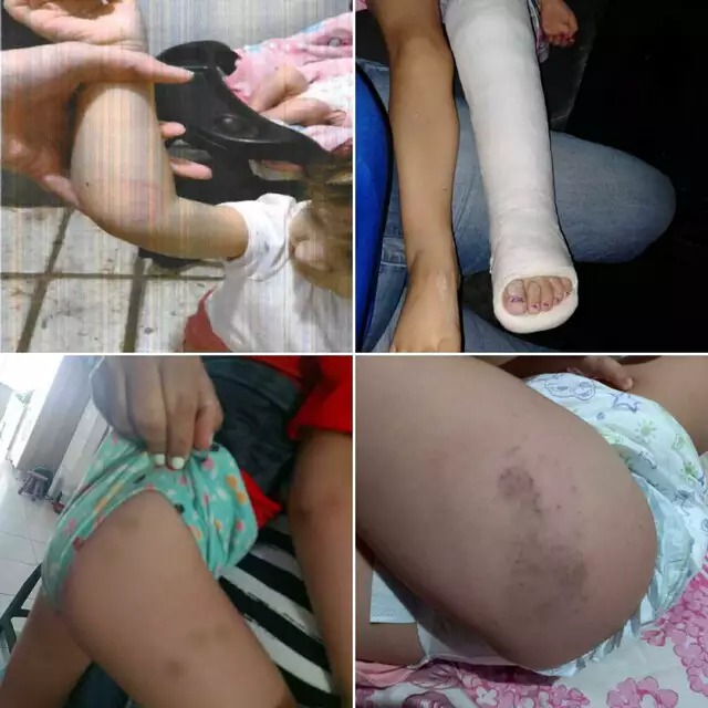 Marcas da violência deixadas no corpo da criança