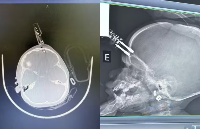  A principal hipótese é que a menina estava com o carregador na mão quando caiu da cama e o objeto atingiu a cabeça de forma que perfurou a região frontal do crânio, perto do olho.