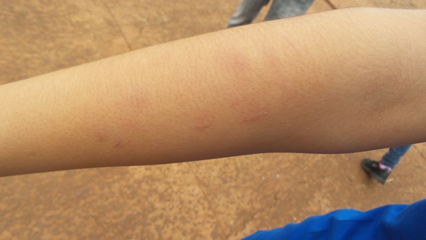 A jovem agredida teve ferimentos no braço e no rosto - Foto: Tayná Biazus