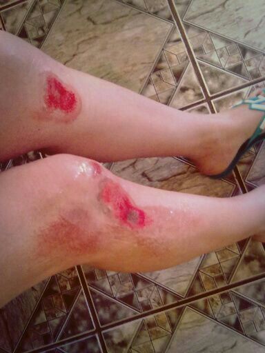  Ferimentos na perna de Fernanda depois do acidente<br />Foto: arquivo pessoal