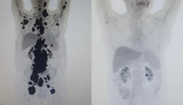 Exames mostram antes e depois de câncer de paciente; à direita, imagem mostra remissão da doença  Foto: Arquivo pessoal